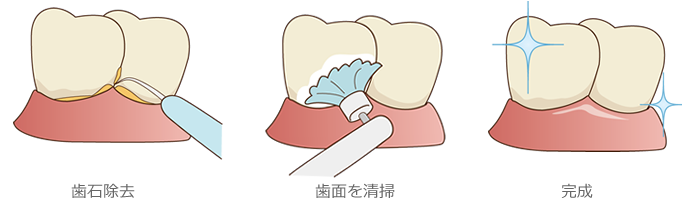 歯のクリーニング（PMTC）の流れ